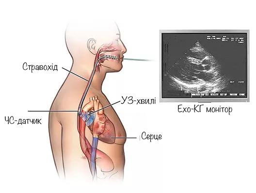 трансезофагальне ехо